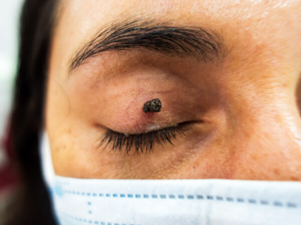 Lesión cutánea de la cara y cuello. SIN BIOPSIA