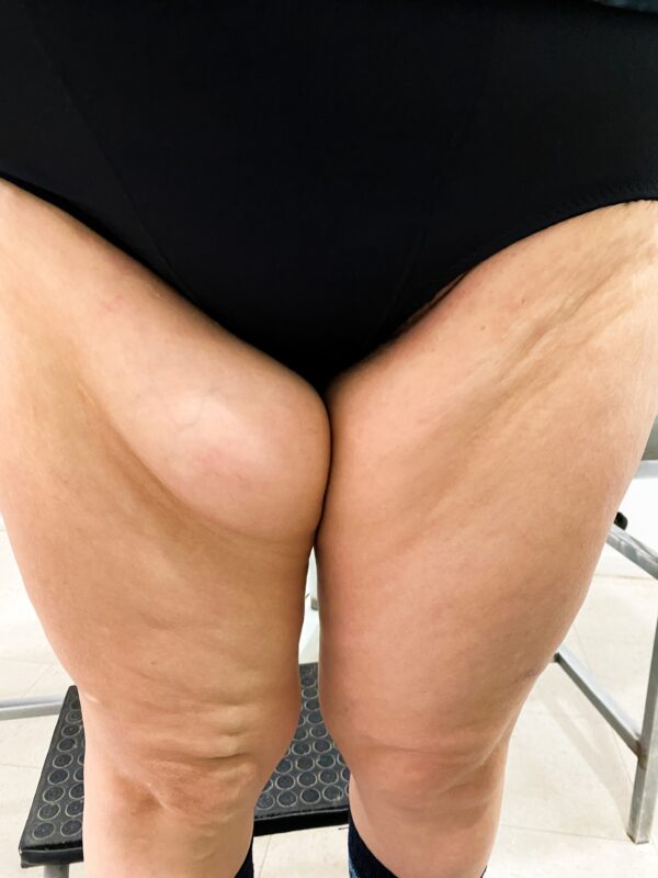 Tumor benigno subcutáneo (Lipoma o Quiste) Resto del Cuerpo. CON BIOPSIA