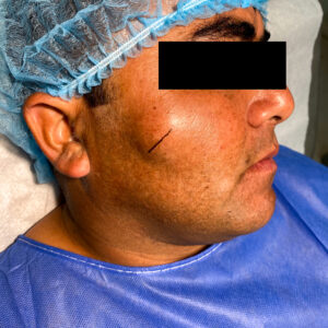 Tumor benigno (lipoma o quiste subdérmico) de la cara o el cuello o genitales CON BIOPSIA.