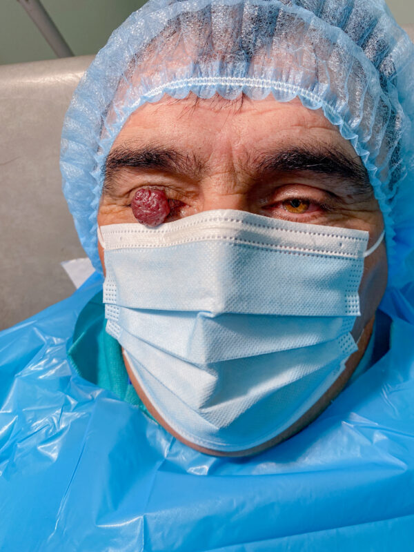 Lesión cutánea de la cara y cuello. CON BIOPSIA