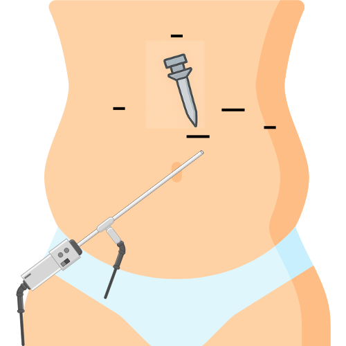 cirugia minimamente invasiva en adolescentes V región