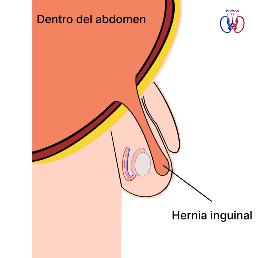 Diagrama de hernia inguinal pediátrica. Consultas y cirugía en Viña del Mar, Quilpué y La Calera - Dr. Martínez