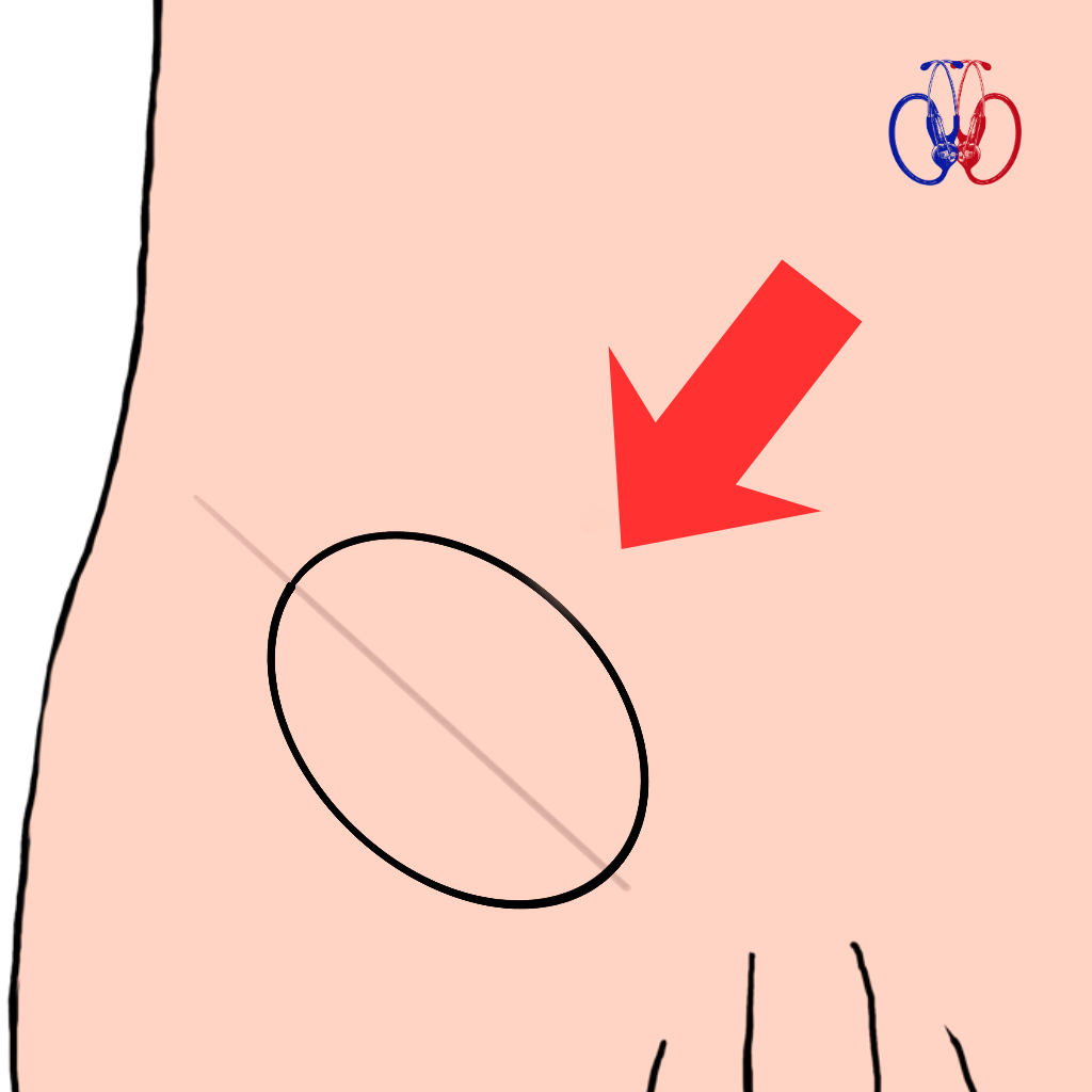 Masa dura en la ingle que no desaparece al tacto, signo de hernia inguinal encarcerada. Evaluación de urgencia en Clínica Los Carrera, Quilpué.