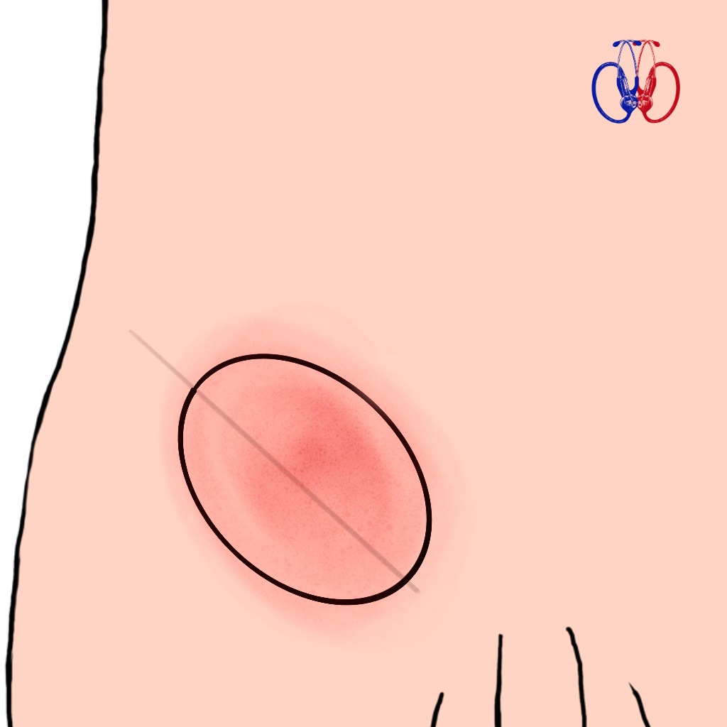 Cambio de coloración en la piel (rojo o morado) sobre una hernia inguinal. Signo de estrangulación herniaria. Atención inmediata en La Calera y Quillota.
