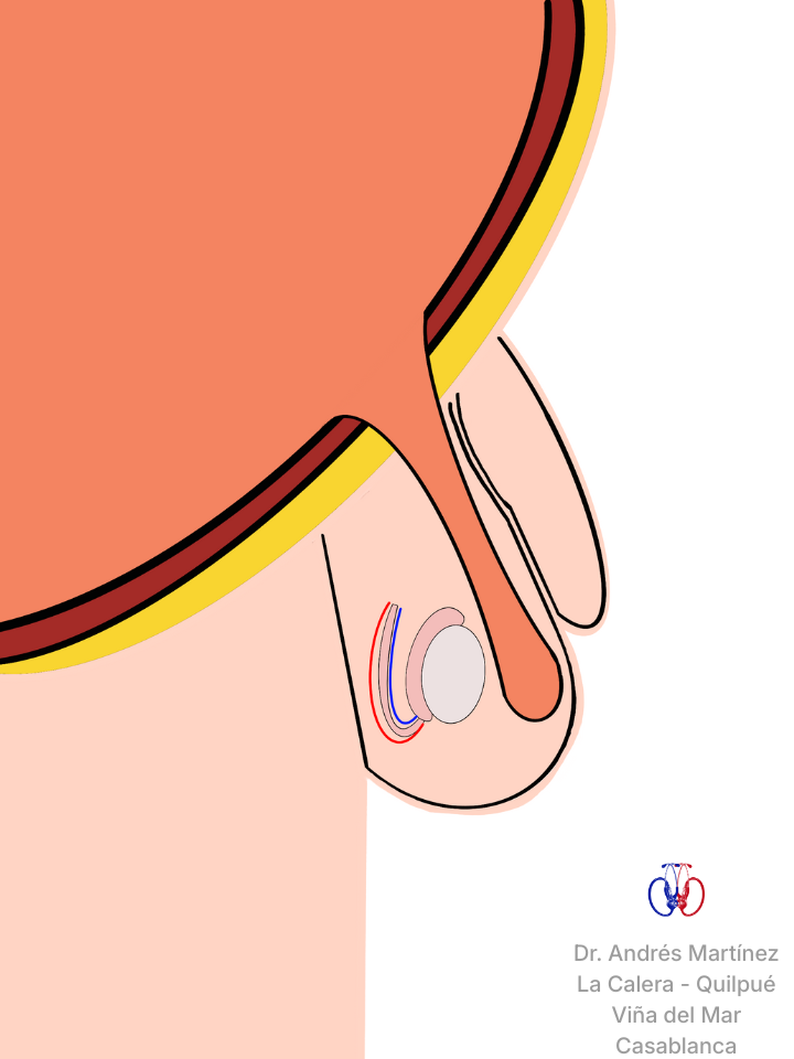 Diagrama de hernia inguinal pediátrica mostrando el conducto peritoneo-vaginal abierto. Especialista en cirugía infantil en Viña del Mar, Quilpué y Calera.
