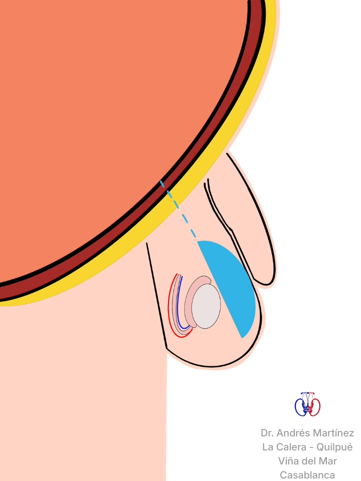 Ilustración de hidrocele no comunicante con líquido atrapado en el escroto. Evaluación quirúrgica pediátrica en La Calera, Quillota y alrededores.