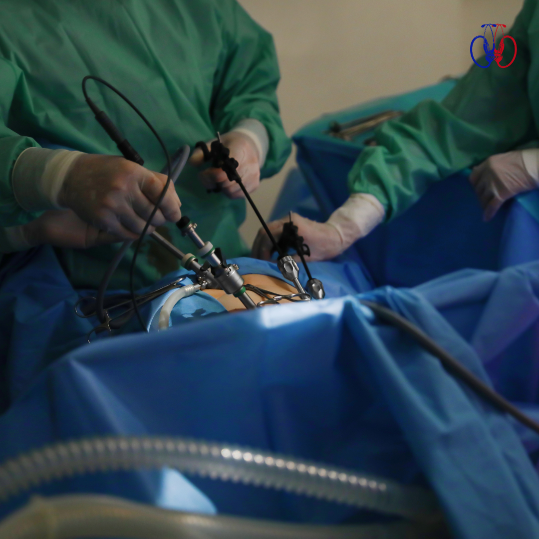 apendicectomía laparoscópica